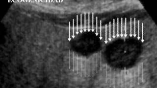 01 Ecografía Hepatobiliopancreática Fundamentos Básicos [upl. by Nilorac]