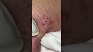 Big Cystic Acne Blackheads Extraction Blackheads amp Milia Whiteheads Removal Pimple Popping shorts [upl. by Tung]