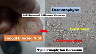 Fungal Infected Nail Microscopy showing Hyphae and Chlamydospores of Dermatophytes [upl. by Gerbold]