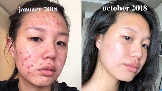 Acne Skincare Routine FINALLY [upl. by Emmi]