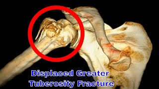 Displaced Greater Tuberosity Fracture [upl. by Anasor]