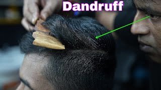 Satisfying Dandruff Removal From Dry Sculp  ASMR Dandruff Removal  Dandruff Treatment With Comb [upl. by Paula]