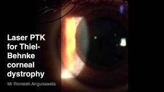 Laser PTK for Anterior Stromal Corneal Dystrophy [upl. by Anaihs491]