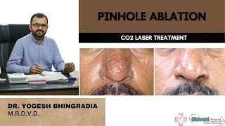 PAPULAR SCAR OF NOSE  PINHOLE ABLATION  CO2 LASER  DR YOGESH BHINGRADIA [upl. by Quinton]