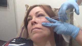 Cheek Augmentation with Juvederm Volift [upl. by Nynnahs]