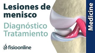 😩😩ROTURA DE MENISCO ► Diagnóstico y tratamiento de fisioterapia médico y quirúrgico [upl. by Atiuqam]