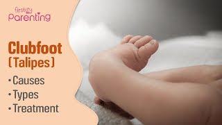 Club Foot Talipes in Babies  Causes Signs amp Treatment [upl. by Nicolea]