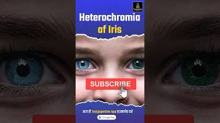 heterochromia of iris  Different Colored Eyes heterochromia eyes ophthalmology testpaperlive [upl. by Juni12]