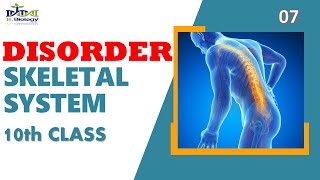 Disorder of Skeletal system  10th Class  BurhanBiology [upl. by Eivlys]