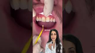 Composite bonding  chipped tooth repair  chipped front tooth filling  Dr Yazdan  dental filling [upl. by Mose]