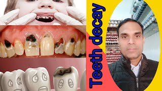 Homoeopathy medicines for teeths decay दांतों की सड़न के लिए होम्योपैथी दवा [upl. by Pepillo]