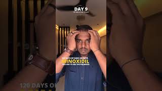 Im Using Minoxidil Daily for 5 Days to STOP Hair Loss  Day 9 minoxidil dermaroller hairloss [upl. by Hamlen]