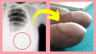 Top 10 WARNING signs of Lung Cancer [upl. by Nah456]