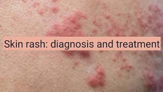 Skin Rash diagnosis and treatment [upl. by Cornell]