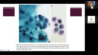 SISTEMA BETHESDA PARA EL REPORTE DE CITOLOGIA CERVICAL  PARTE 2 [upl. by Mandy526]