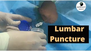 Lumbar Puncture Procedure in just 11 mins [upl. by Kernan]