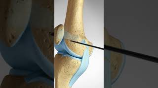 What happens when you dislocate your Knee Cap MPFL Tears and Reconstruction kneeanatomy [upl. by Frech]