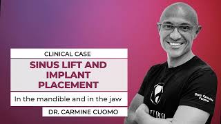 Sinus Lift and Implant Placement by Dr Carmine Cuomo Magnetic Mallet [upl. by Anawal]