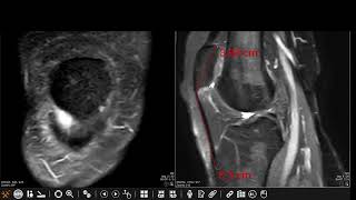 Patellar tendonlateral femoral condyle friction syndrome Hoffa fat pad impingement syndrome [upl. by Joell]