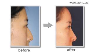 Korea Rhinoplasty AsiaKorea plastic surgery Before and After 1 [upl. by Dopp]