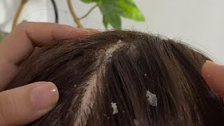 ASMR  Dandruff Removal amp Scalp Check Extremely Satisfying [upl. by Nnyleuqcaj210]