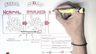 ENT Pathology Intraepithelial Dysplasia amp Squamous Cell Carcinoma w Dr Wenig [upl. by Eyahsal]