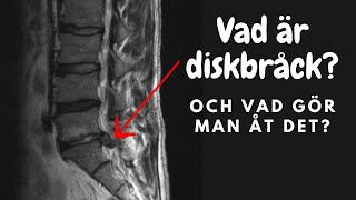 Vad är diskbråck och vad gör man åt det [upl. by Girand]