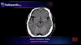 Stroke Acute infarction  radiology video tutorial CT MRI angiography [upl. by Rex493]