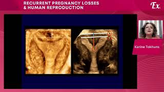 Mullerian duct anomalies obgyn medical pregnancy obstetrician [upl. by Deni]