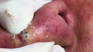 cystic acne blackhead whitehead removal  Relaxing Spa Acne Treatment [upl. by Riccardo]