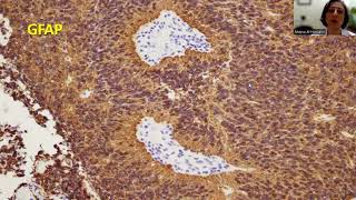 Tip14 H3K27me3 in Ependymoma [upl. by Lev989]