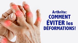 Arthrite  comment ÉVITER les déformations [upl. by Salamone]