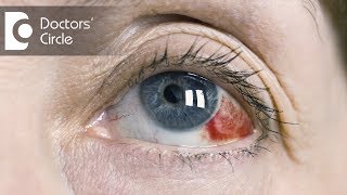 Causes of red clots in eyes  Dr Mala Suresh [upl. by Yzus860]