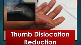 Thumb Dislocation Reduction [upl. by Pacian]