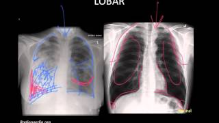 Pneumonia Imaging [upl. by Ottilie108]