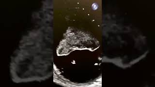 Massive Left Ventricular Thrombus echocardiography echocardiogram cardiology [upl. by Kcirdnekel]