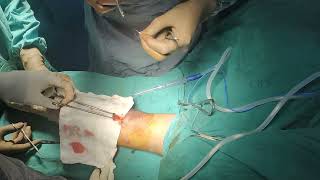 Biceps tendon avulsion repair [upl. by Nyladam615]