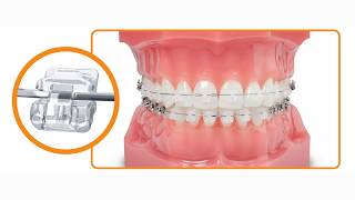 Which braces are better Damon Clear or Damon Metal [upl. by Natsreik]