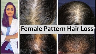 Hair loss in women  Female Pattern Hair Loss  causes amp treatment  Dermatologist [upl. by Ahsihat]