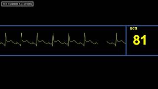 ST Elevation Rhythm Waveform  Simulated Patient Waveform [upl. by Natty]