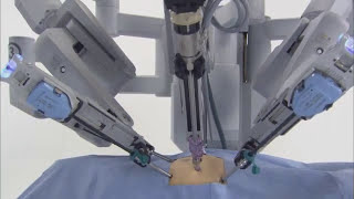 da Vinci® Robotic Surgical System [upl. by Eixel522]