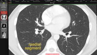 Lobar and Segmental Lung Anatomy on CT [upl. by Philina598]