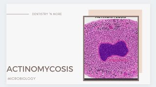 ACTINOMYCOSIS [upl. by Eibur285]