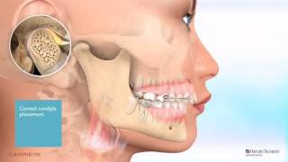 Carriere® Motion™ Appliance for Class II Patient Education Animation [upl. by Norita]