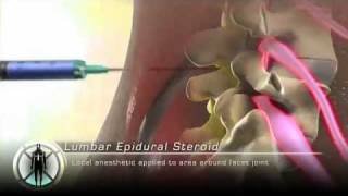 Lumbar Epidural Steroid Injection [upl. by Allard]