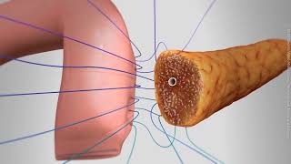 Twolayer bowel anastomosisstyle pancreaticojejunostomy quotDunkquot PJ technique [upl. by Ainaj]