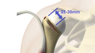 Proximal Biceps Repair [upl. by Ebehp]