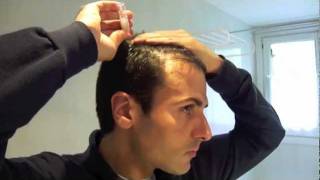 Tratamiento laser capilar domiciliario  Hair loss laser treatment home use [upl. by Namzaj904]