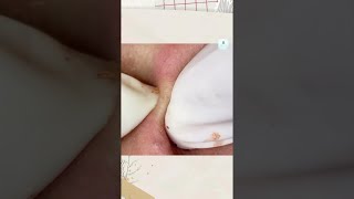 Big Cystic Acne Blackheads Extraction Blackheads amp Milia Whiteheads Removal Pimple Popping [upl. by Tewell]