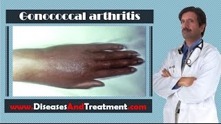 Gonococcal arthritis  Causes Diagnosis Symptoms Treatment Prognosis [upl. by Kcirrej]